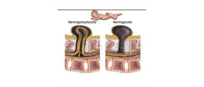 Spina Bifida Meningomyelosel
