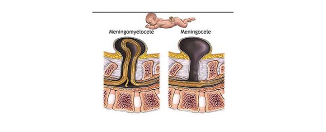 Spina Bifida Meningomyelosel